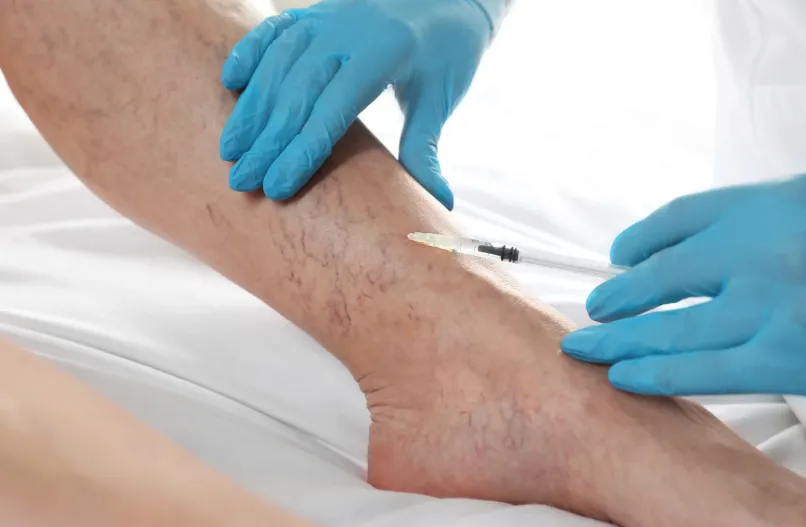 Sclerotherapy for spider veins